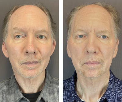 Ear Surgery Before & After Gallery - Patient 122127324 - Image 1