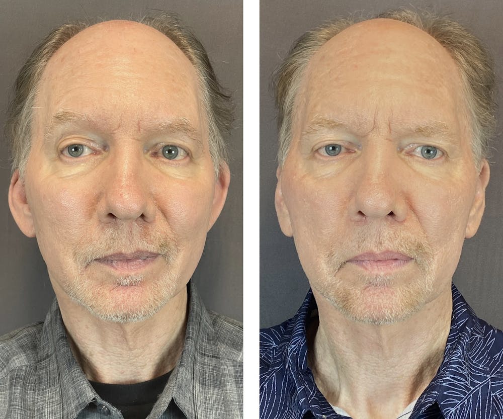 Ear Surgery Before & After Gallery - Patient 122127324 - Image 1