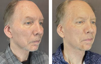 Ear Surgery Before & After Gallery - Patient 122127324 - Image 2