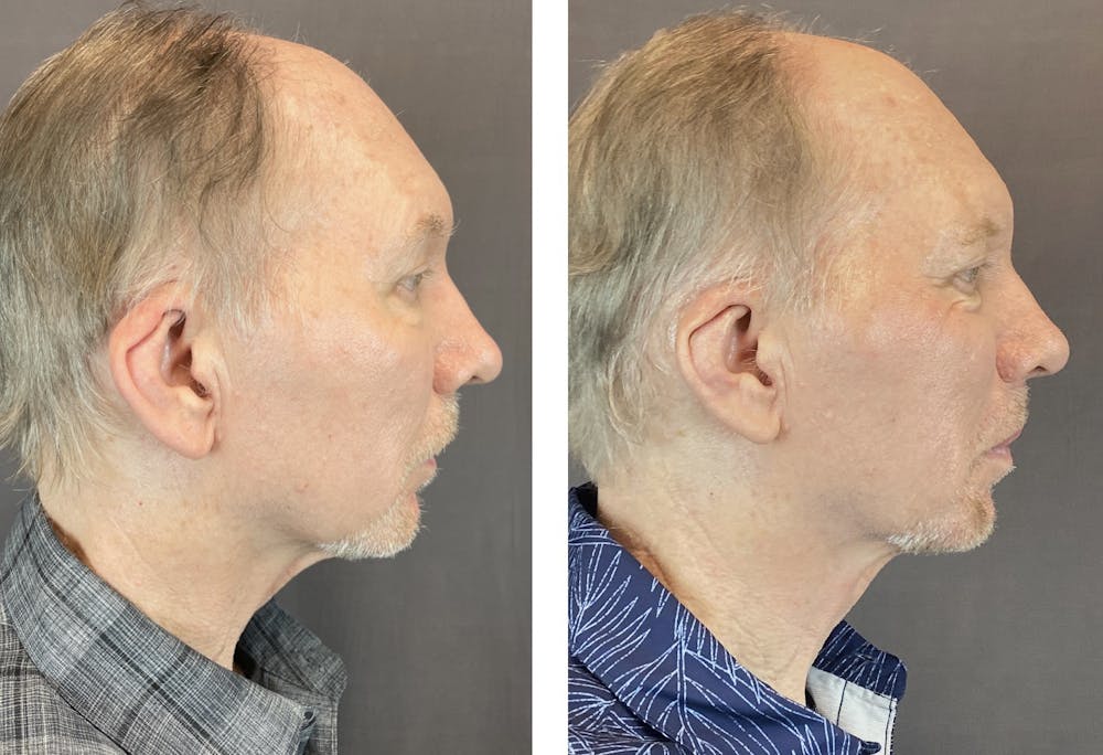Ear Surgery Before & After Gallery - Patient 122127324 - Image 3
