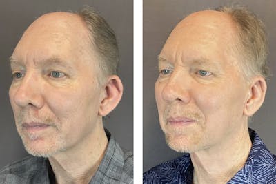 Ear Surgery Before & After Gallery - Patient 122127324 - Image 4