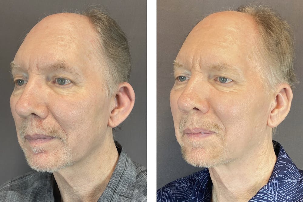 Ear Surgery Before & After Gallery - Patient 122127324 - Image 4