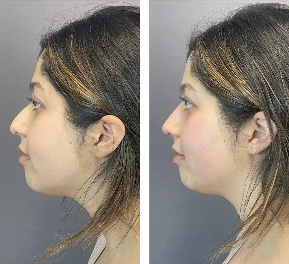 Non-Surgical Rhinoplasty Before & After Gallery - Patient 122127453 - Image 2