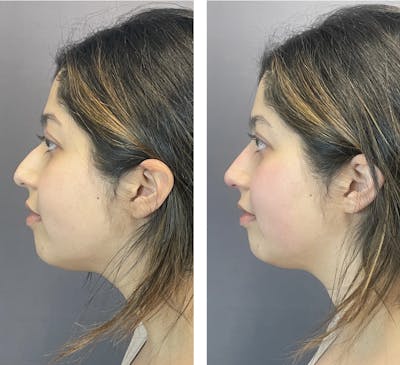 Non-Surgical Rhinoplasty Before & After Gallery - Patient 122127453 - Image 2