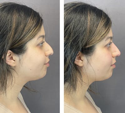 Non-Surgical Rhinoplasty Before & After Gallery - Patient 166984 - Image 1