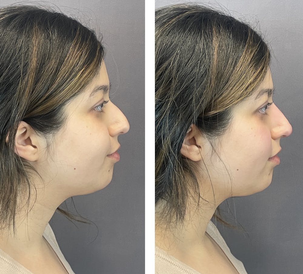 Non-Surgical Rhinoplasty Before & After Gallery - Patient 122127453 - Image 1