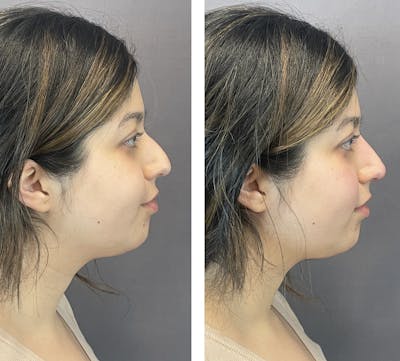 Non-Surgical Rhinoplasty Before & After Gallery - Patient 122127453 - Image 1