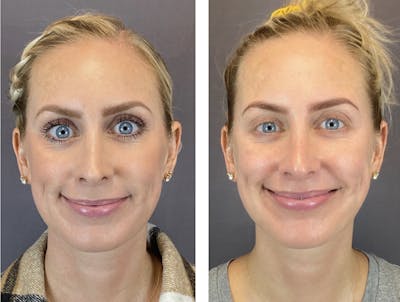 Non-Surgical Rhinoplasty Before & After Gallery - Patient 122127452 - Image 2