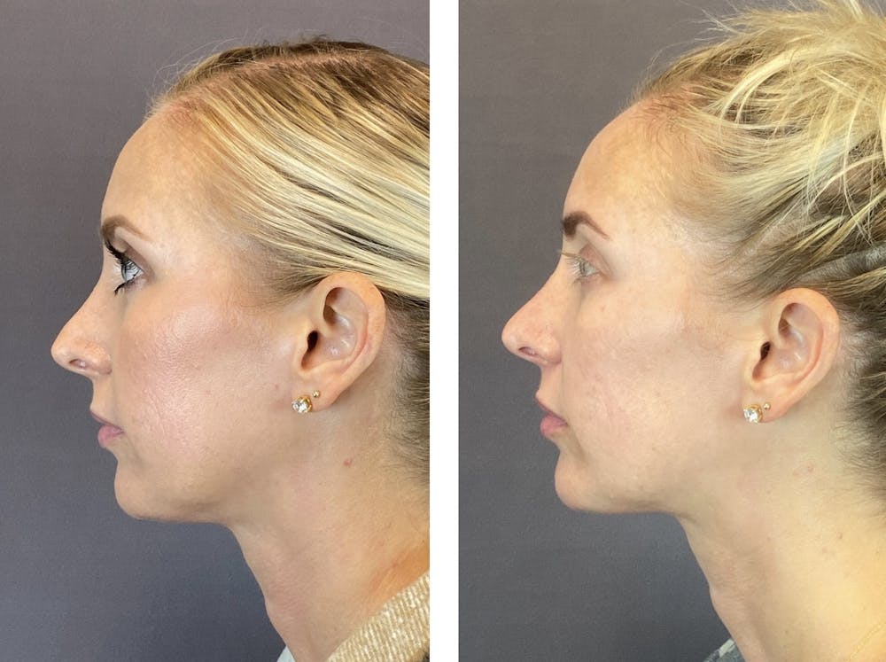 Non-Surgical Rhinoplasty Before & After Gallery - Patient 122127452 - Image 3