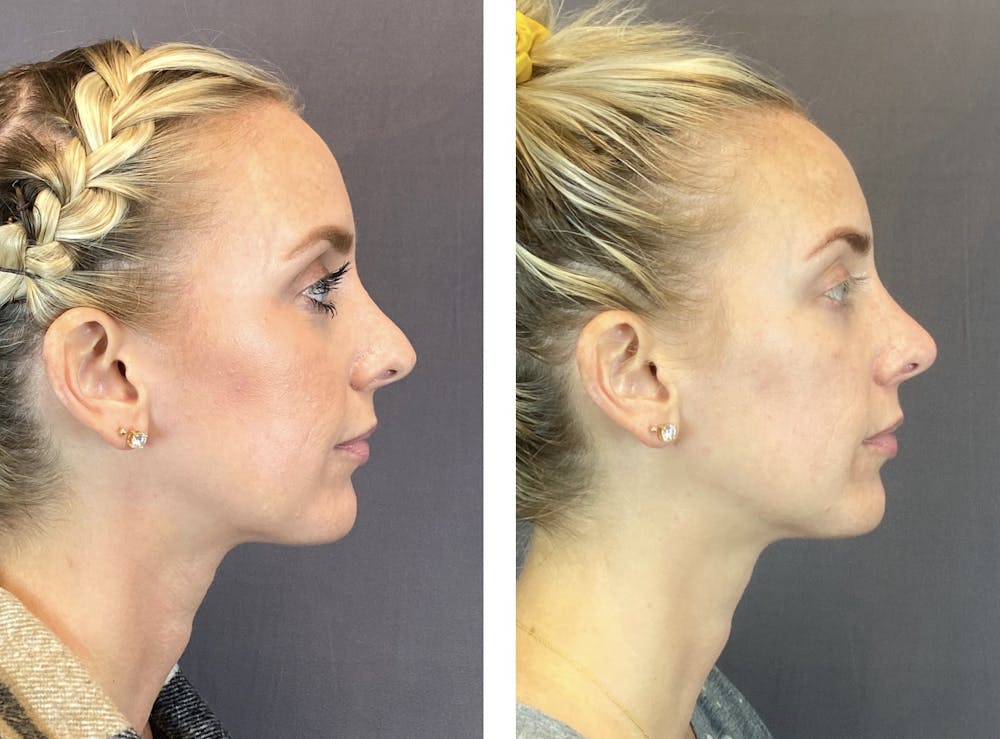 Non-Surgical Rhinoplasty Before & After Gallery - Patient 122127452 - Image 1