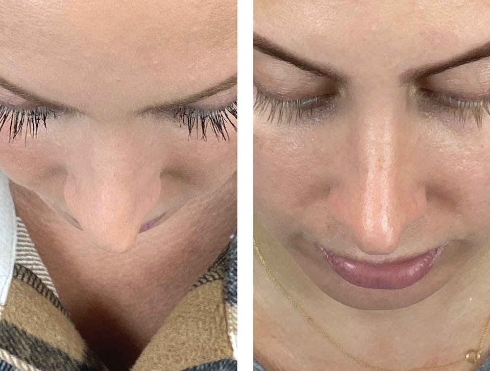Non-Surgical Rhinoplasty Before & After Gallery - Patient 146995 - Image 4