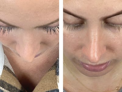 Non-Surgical Rhinoplasty Before & After Gallery - Patient 122127452 - Image 4