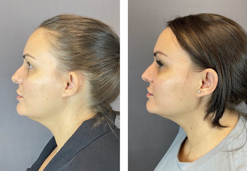 Ear Surgery Before & After Gallery - Patient 122594892 - Image 3