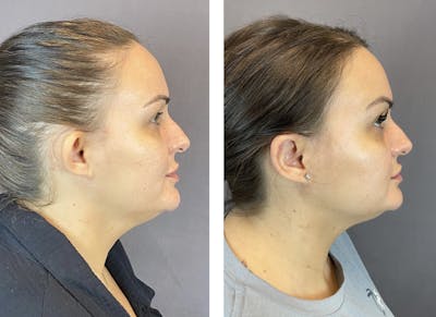 Ear Surgery Before & After Gallery - Patient 122594892 - Image 2