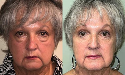 Lower Blepharoplasty Before & After Gallery - Patient 122622909 - Image 1