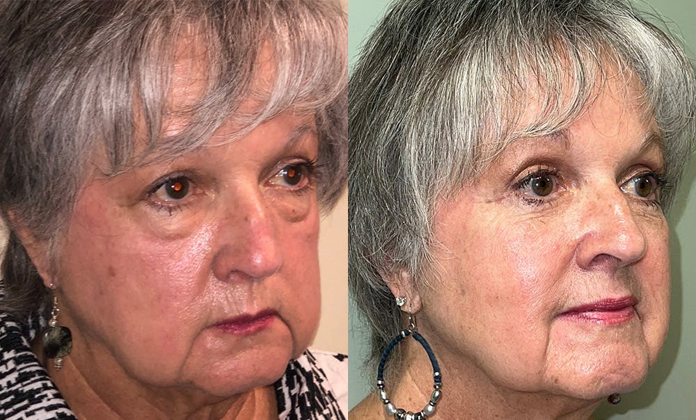 Lower Blepharoplasty Before & After Gallery - Patient 122622909 - Image 2
