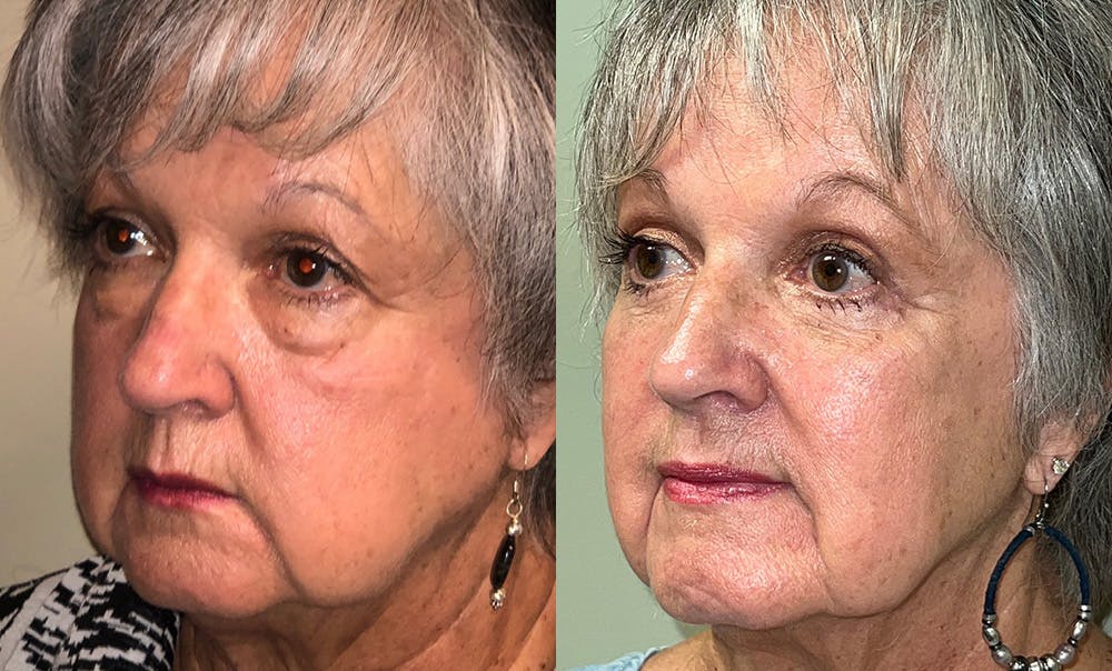 Lower Blepharoplasty Before & After Gallery - Patient 122622909 - Image 3