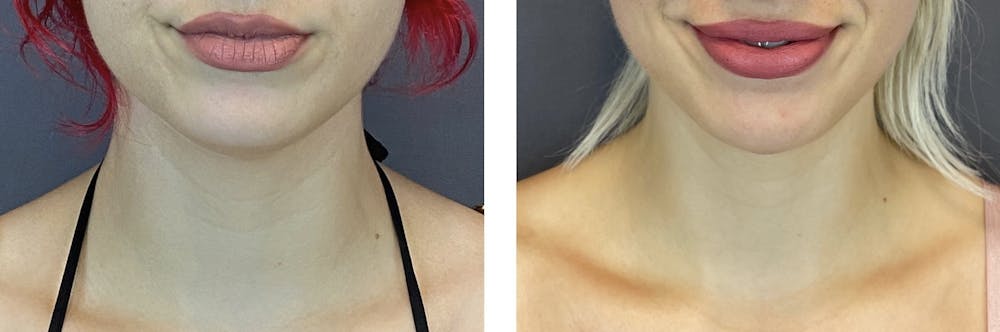 Submental Liposuction Before & After Gallery - Patient 122889062 - Image 1