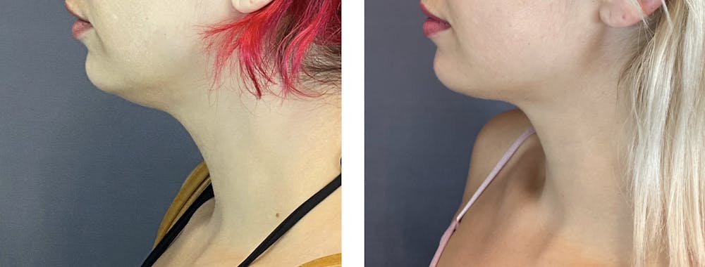 Submental Liposuction Before & After Gallery - Patient 122889062 - Image 2