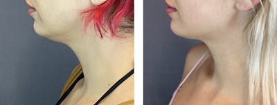 Facetite Before & After Gallery - Patient 122889109 - Image 1