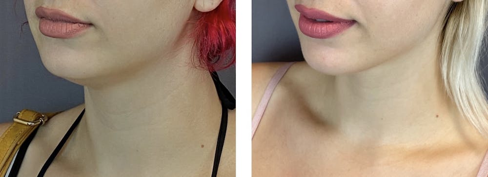 Facetite Before & After Gallery - Patient 122889109 - Image 3