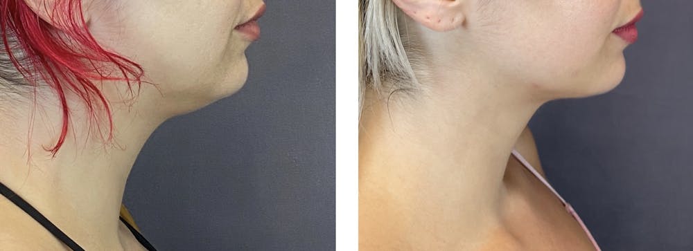 Facetite Before & After Gallery - Patient 122889109 - Image 4