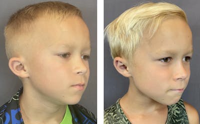 Ear Surgery Before & After Gallery - Patient 122889121 - Image 2