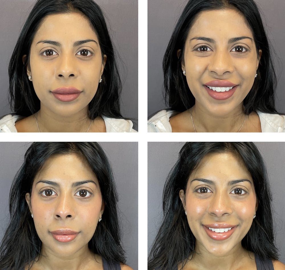 Buccal Fat Reduction Before & After Gallery - Patient 122889128 - Image 1