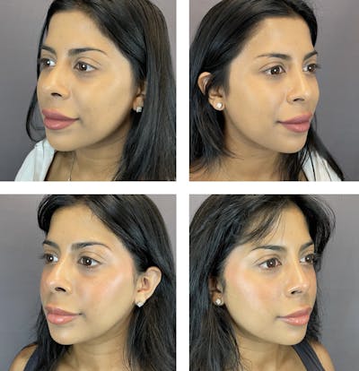 Buccal Fat Reduction Before & After Gallery - Patient 122889128 - Image 2