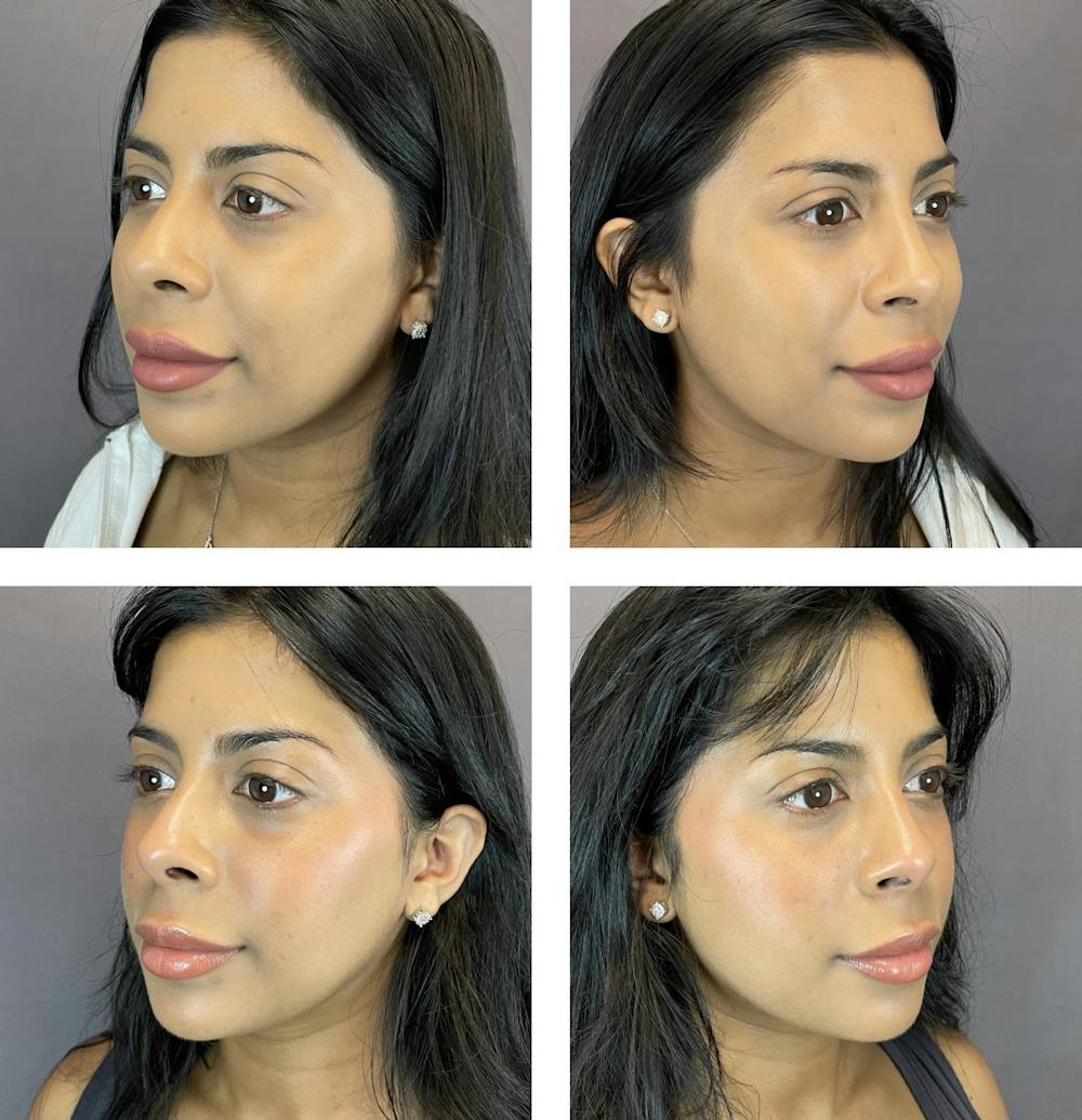 Buccal Fat Reduction Before & After Gallery - Patient 122889128 - Image 2