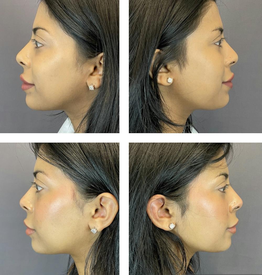 Buccal Fat Reduction Before & After Gallery - Patient 122889128 - Image 3