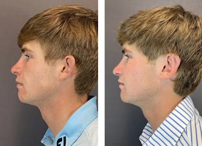 Ear Surgery Before & After Gallery - Patient 122889157 - Image 2