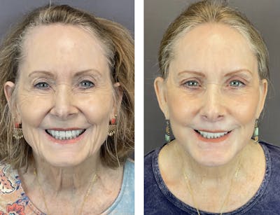 Upper Blepharoplasty Before & After Gallery - Patient 122889167 - Image 1
