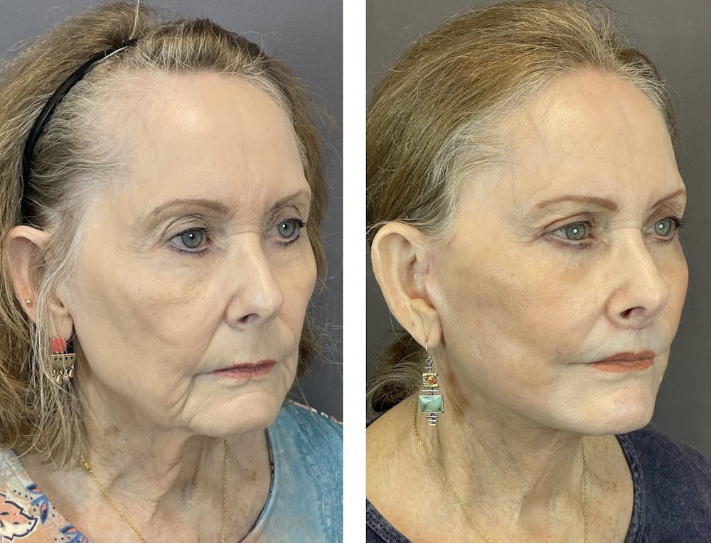 Upper Blepharoplasty Before & After Gallery - Patient 122889167 - Image 2
