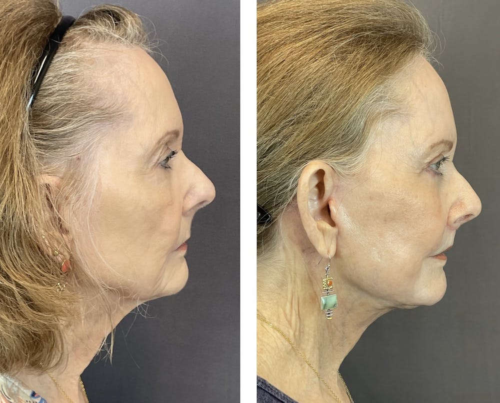 Necklift Before & After Gallery - Patient 122889162 - Image 3