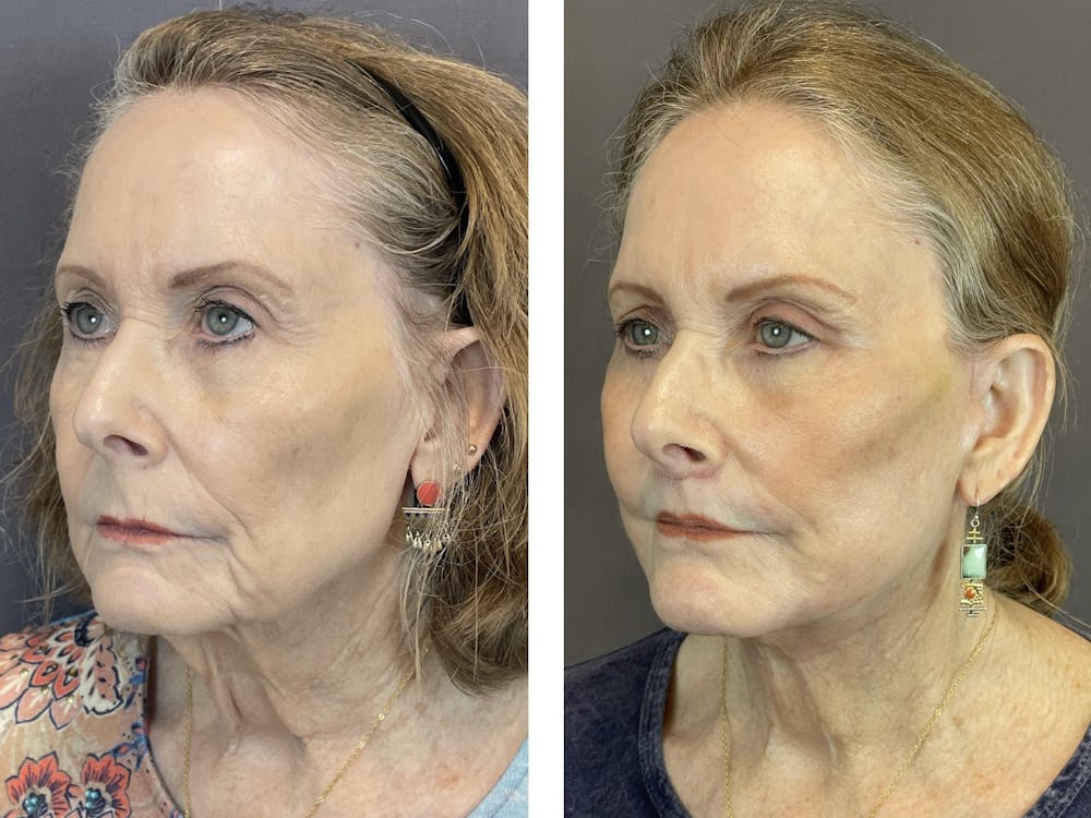 Upper Blepharoplasty Before & After Gallery - Patient 122889167 - Image 4