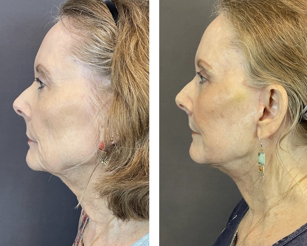 Necklift Before & After Gallery - Patient 122889162 - Image 5