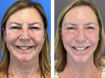 Necklift Before & After Gallery - Patient 122889202 - Image 1