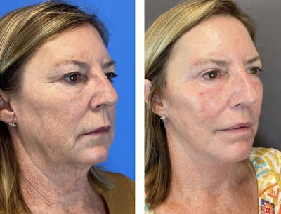 Necklift Before & After Gallery - Patient 122889202 - Image 2
