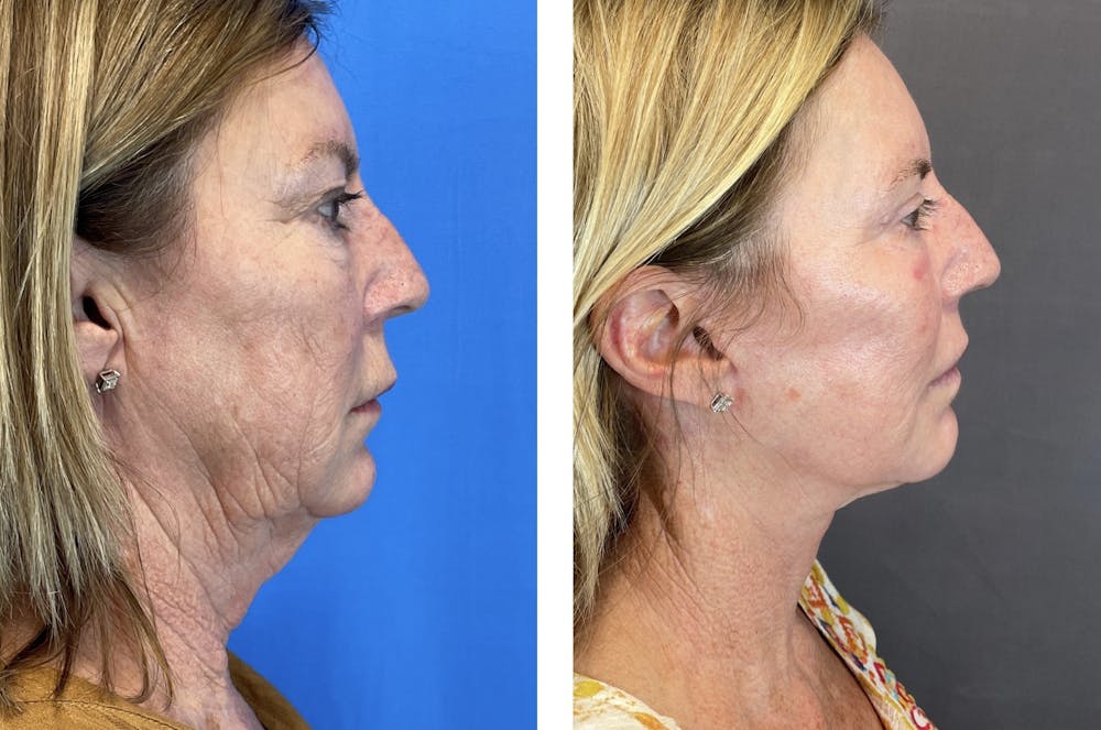 Necklift Before & After Gallery - Patient 122889202 - Image 3