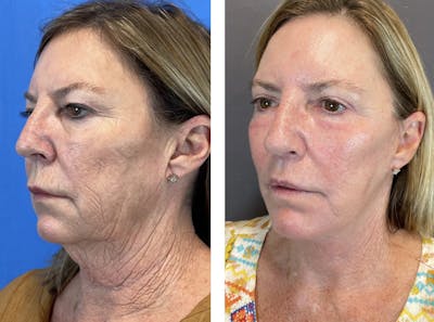 Upper Blepharoplasty Before & After Gallery - Patient 122889206 - Image 4