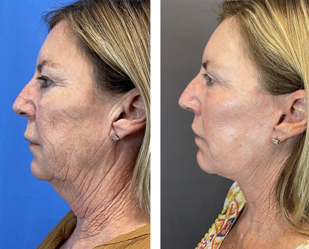 Necklift Before & After Gallery - Patient 122889202 - Image 5