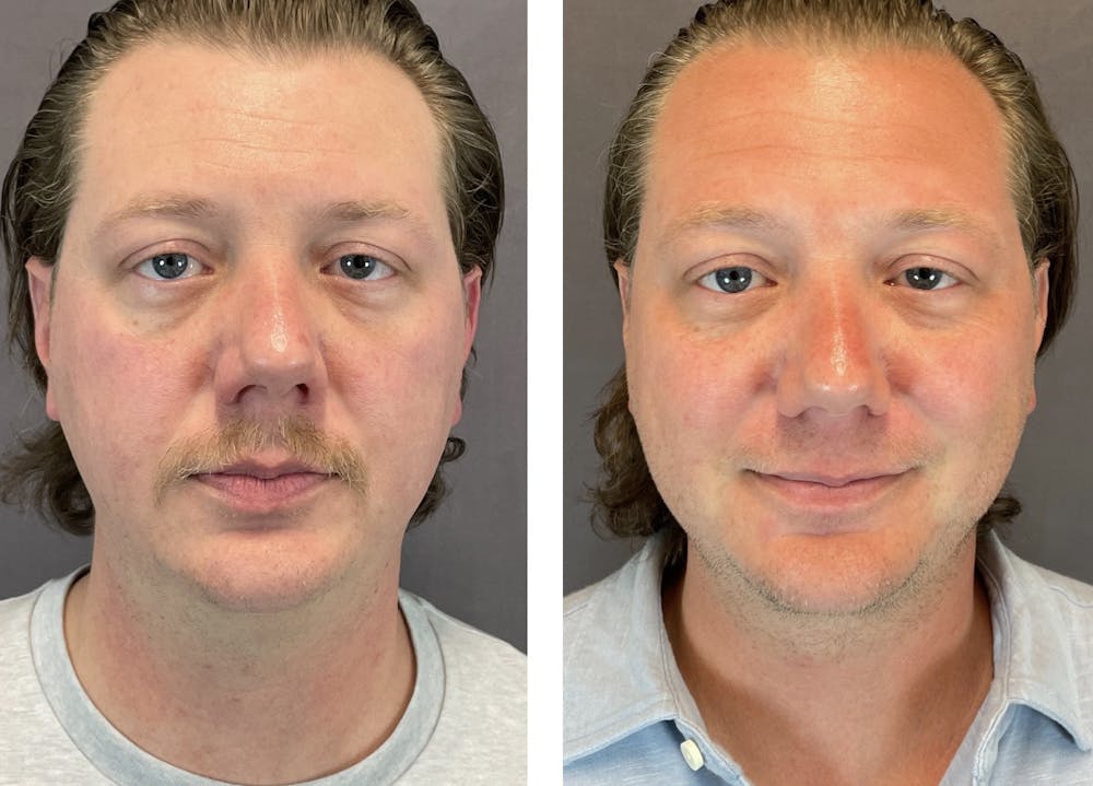 Necklift Before & After Gallery - Patient 122889231 - Image 1