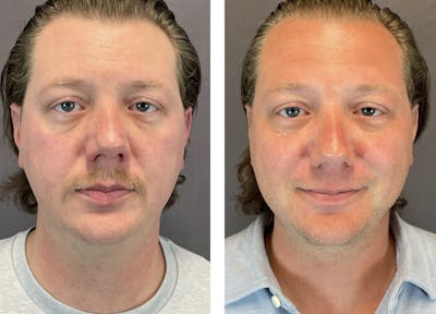 Necklift Before & After Gallery - Patient 122889231 - Image 1