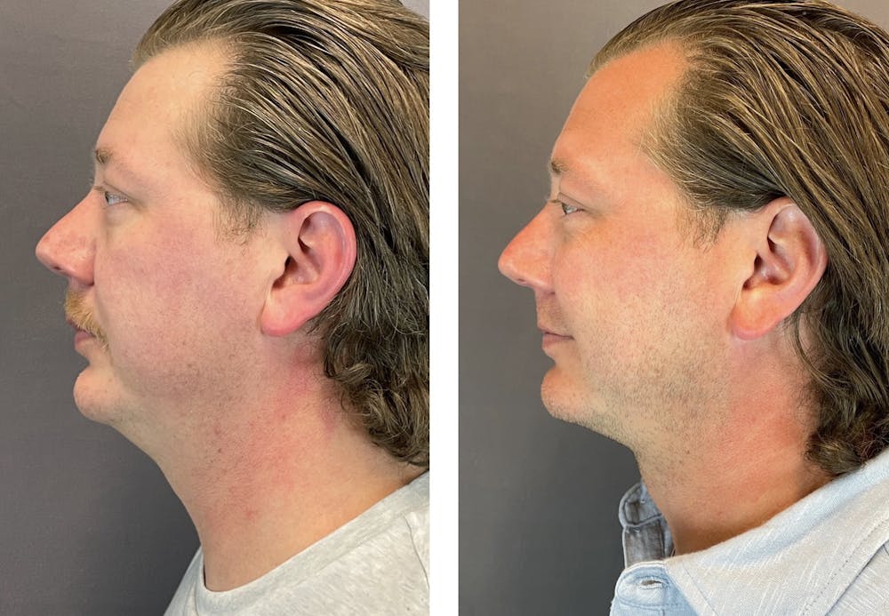 Necklift Before & After Gallery - Patient 122889231 - Image 2