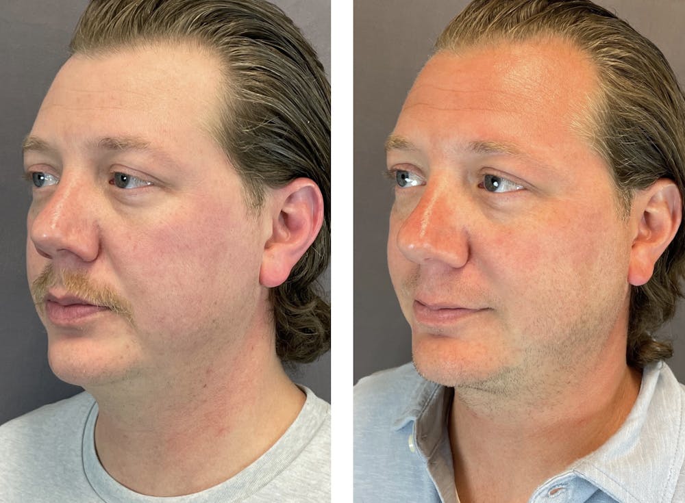 Necklift Before & After Gallery - Patient 122889231 - Image 3