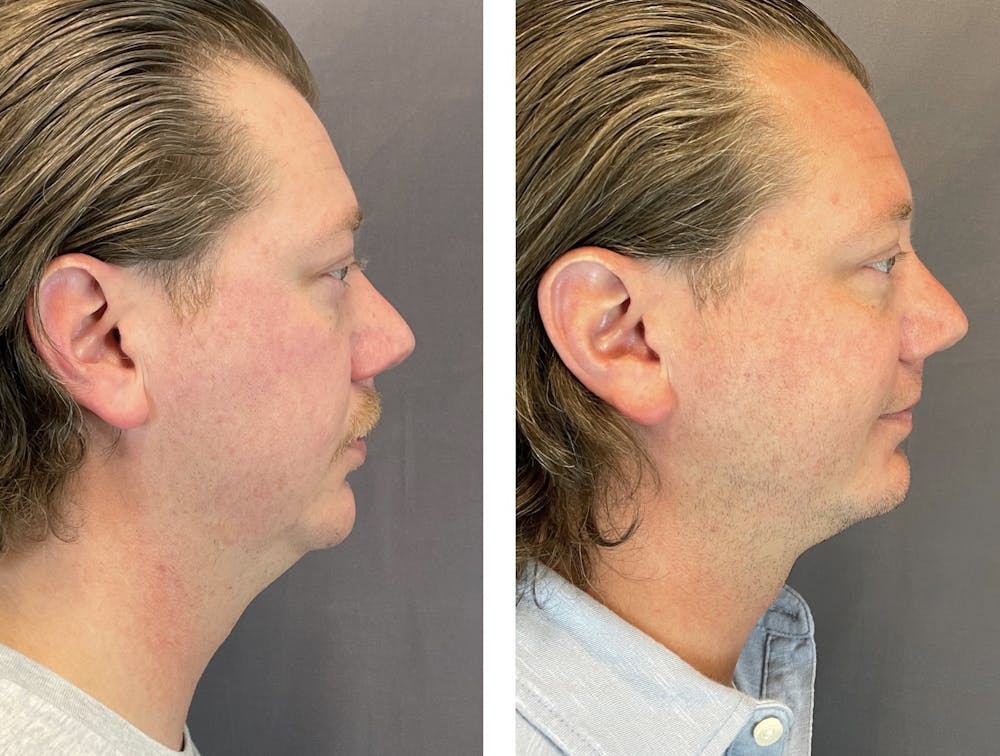Necklift Before & After Gallery - Patient 122889231 - Image 4
