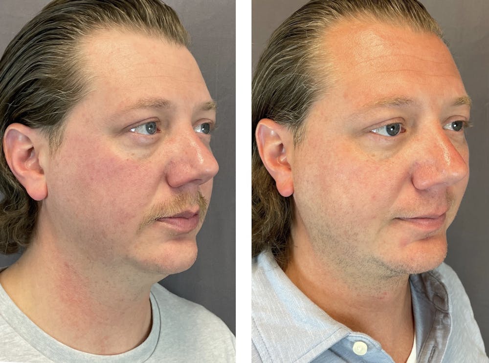 Necklift Before & After Gallery - Patient 122889231 - Image 5