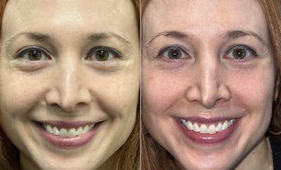 Lower Blepharoplasty Gallery - Patient 123125948 - Image 1