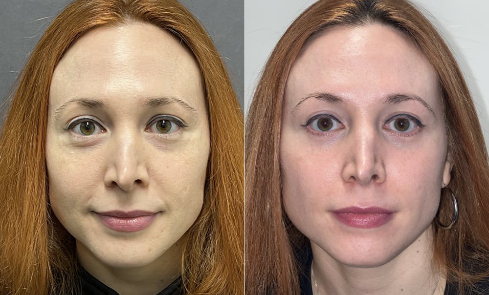 Lower Blepharoplasty Before & After Gallery - Patient 123125948 - Image 2